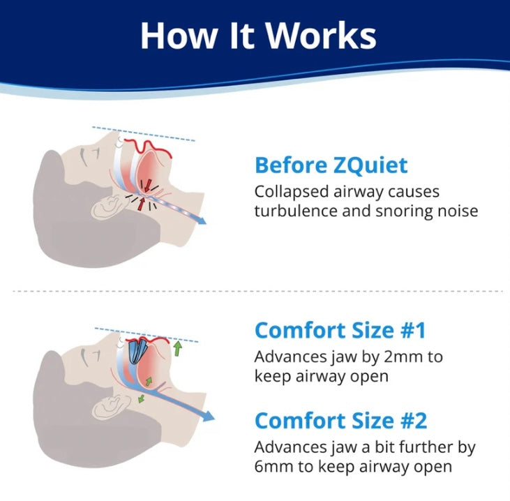 Anti-Snoring Mouthpiece